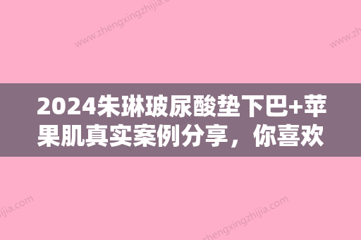 2024朱琳玻尿酸垫下巴+苹果肌真实案例分享，你喜欢吗？