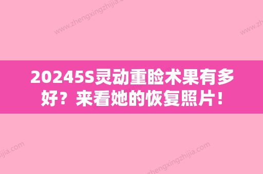 20245S灵动重睑术果有多好？来看她的恢复照片！