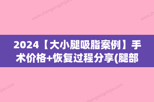 2024【大小腿吸脂案例】手术价格+恢复过程分享(腿部吸脂手术价格)