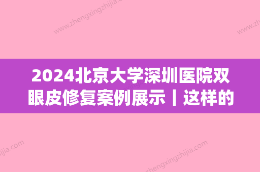 2024北京大学深圳医院双眼皮修复案例展示｜这样的果你羡慕了吗？(深圳双眼皮修复比较好的医生)