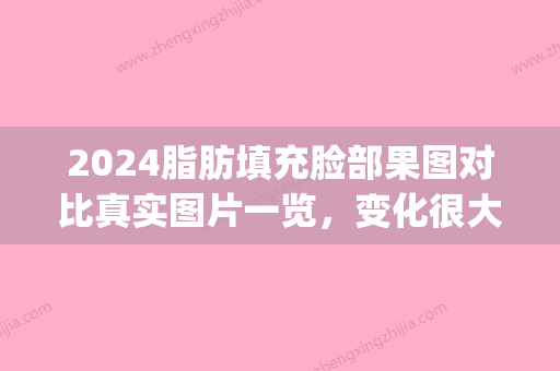 2024脂肪填充脸部果图对比真实图片一览，变化很大(脂肪填充面部对比图)