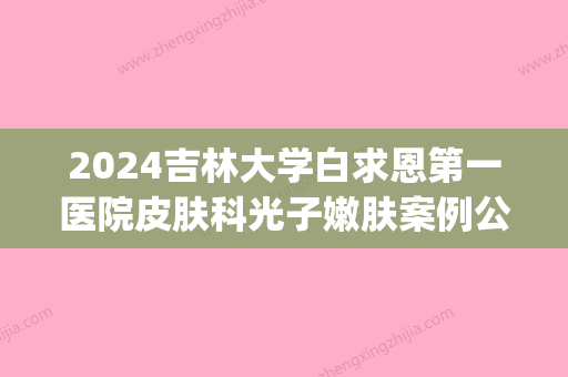 2024吉林大学白求恩第一医院皮肤科光子嫩肤案例公开｜附对比果图(长春白求恩医科大学第一医院皮肤科)