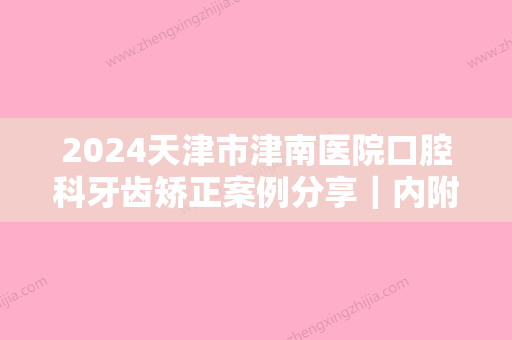 2024天津市津南医院口腔科牙齿矫正案例分享｜内附前后变化果图