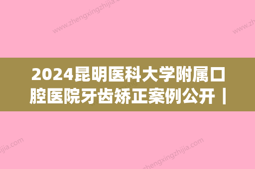 2024昆明医科大学附属口腔医院牙齿矫正案例公开｜内附体验果图(昆明市口腔医院正畸科)