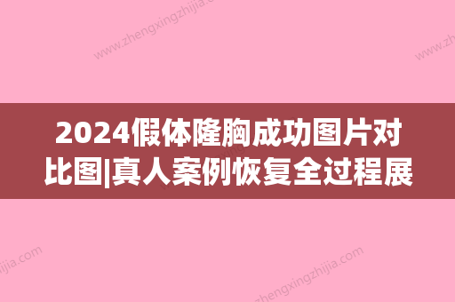 2024假体隆胸成功图片对比图|真人案例恢复全过程展示