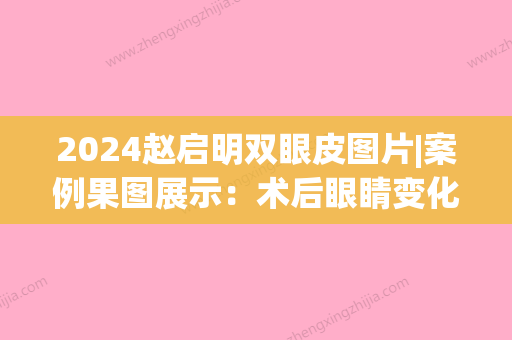 2024赵启明双眼皮图片|案例果图展示：术后眼睛变化超大！