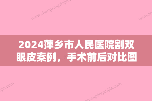 2024萍乡市人民医院割双眼皮案例，手术前后对比图片展示