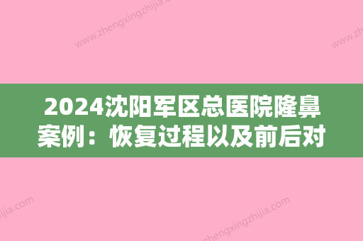 2024沈阳军区总医院隆鼻案例：恢复过程以及前后对比图片展示