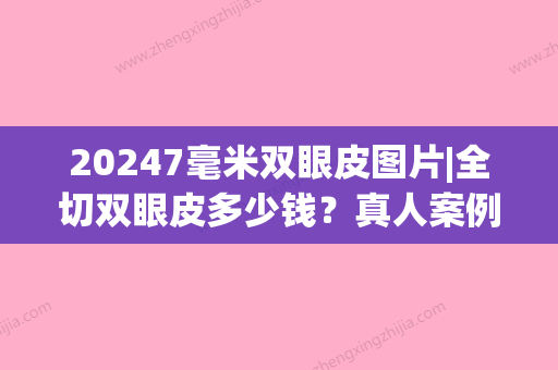 20247毫米双眼皮图片|全切双眼皮多少钱？真人案例展示