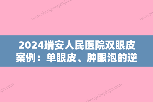 2024瑞安人民医院双眼皮案例：单眼皮、肿眼泡的逆袭之旅！