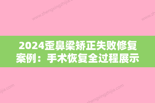 2024歪鼻梁矫正失败修复案例：手术恢复全过程展示&收费标准