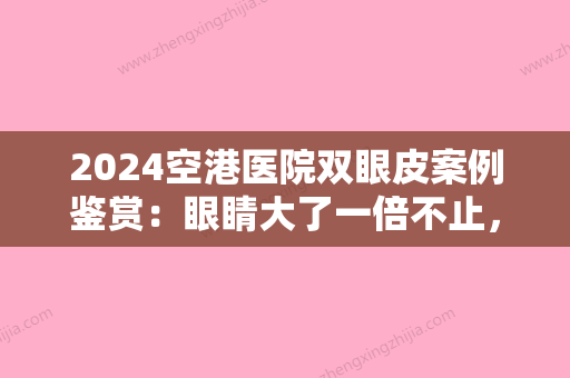 2024空港医院双眼皮案例鉴赏：眼睛大了一倍不止，果超棒!