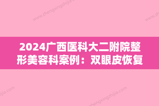 2024广西医科大二附院整形美容科案例：双眼皮恢复后，颜值提升！