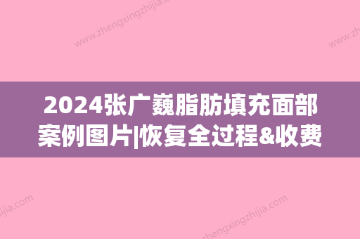 2024张广巍脂肪填充面部案例图片|恢复全过程&收费价格表