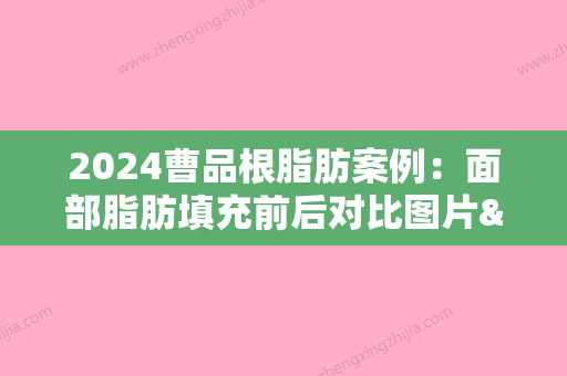 2024曹品根脂肪案例：面部脂肪填充前后对比图片&恢复全过程