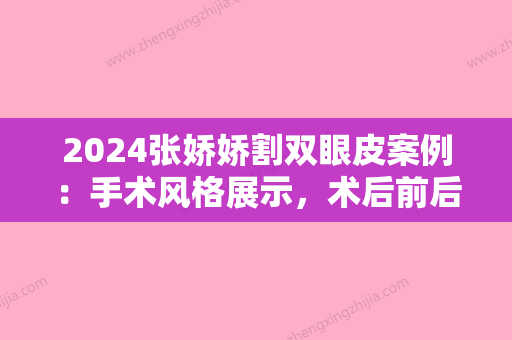 2024张娇娇割双眼皮案例：手术风格展示，术后前后对比图片一览