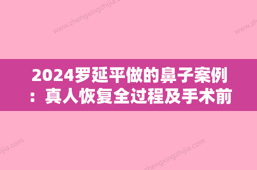 2024罗延平做的鼻子案例：真人恢复全过程及手术前后对比照片