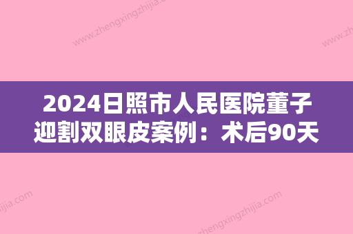 2024日照市人民医院董子迎割双眼皮案例：术后90天，回归少女心