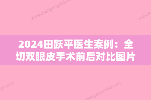 2024田跃平医生案例：全切双眼皮手术前后对比图片展示