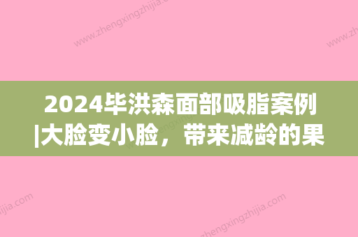 2024毕洪森面部吸脂案例|大脸变小脸，带来减龄的果