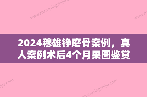 2024穆雄铮磨骨案例，真人案例术后4个月果图鉴赏