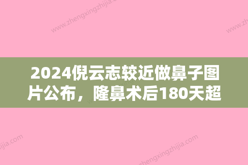 2024倪云志较近做鼻子图片公布，隆鼻术后180天超精致~