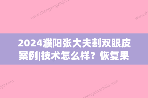 2024濮阳张大夫割双眼皮案例|技术怎么样？恢复果图分享