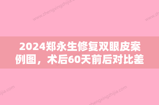 2024郑永生修复双眼皮案例图，术后60天前后对比差异大！