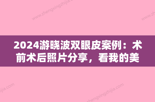 2024游晓波双眼皮案例：术前术后照片分享，看我的美丽蝶变