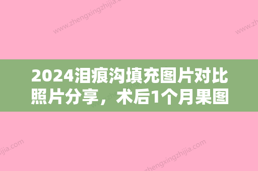 2024泪痕沟填充图片对比照片分享	，术后1个月果图反馈！