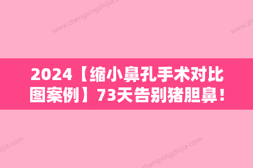 2024【缩小鼻孔手术对比图案例】73天告别猪胆鼻！