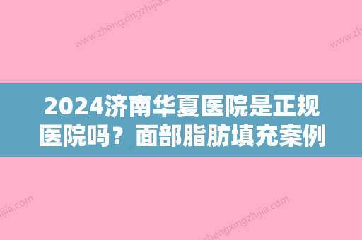 2024济南华夏医院是正规医院吗？面部脂肪填充案例分享