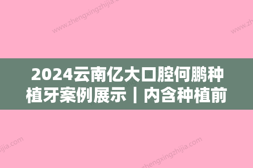 2024云南亿大口腔何鹏种植牙案例展示｜内含种植前后对比图