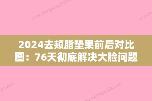 2024去颊脂垫果前后对比图：76天彻底解决大脸问题