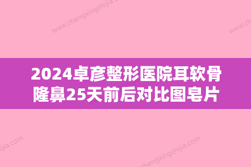 2024卓彦整形医院耳软骨隆鼻25天前后对比图皂片