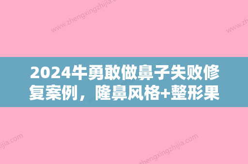 2024牛勇敢做鼻子失败修复案例，隆鼻风格+整形果案例