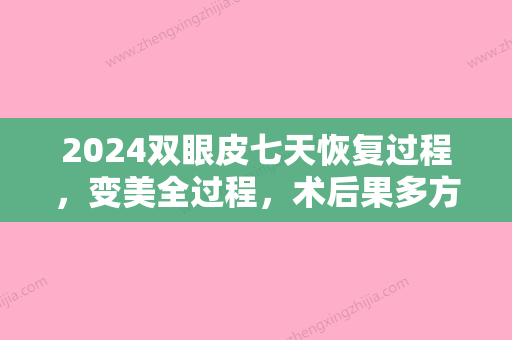 2024双眼皮七天恢复过程，变美全过程，术后果多方面曝光