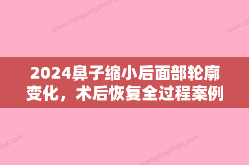 2024鼻子缩小后面部轮廓变化，术后恢复全过程案例！