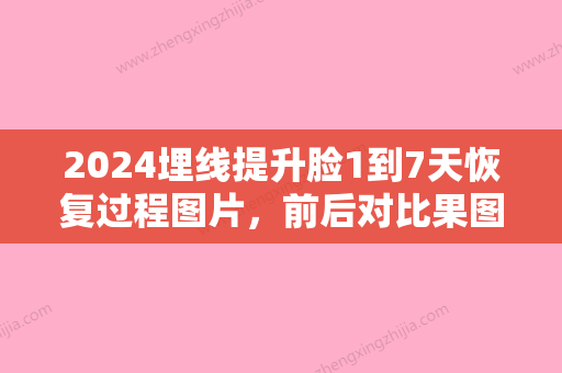 2024埋线提升脸1到7天恢复过程图片，前后对比果图赏析！