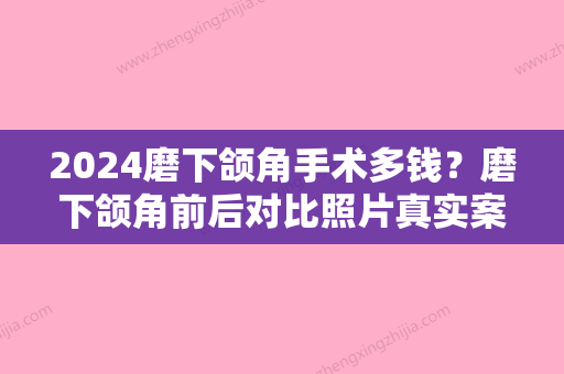 2024磨下颌角手术多钱？磨下颌角前后对比照片真实案例分享