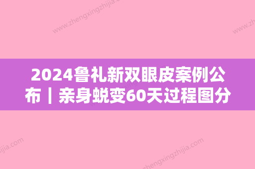 2024鲁礼新双眼皮案例公布｜亲身蜕变60天过程图分享