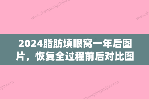 2024脂肪填眼窝一年后图片，恢复全过程前后对比图片分享(脂肪填充恢复期图片)