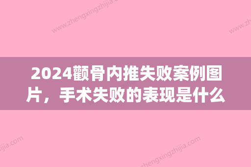 2024颧骨内推失败案例图片，手术失败的表现是什么？(颧骨内推失败可以复位吗)