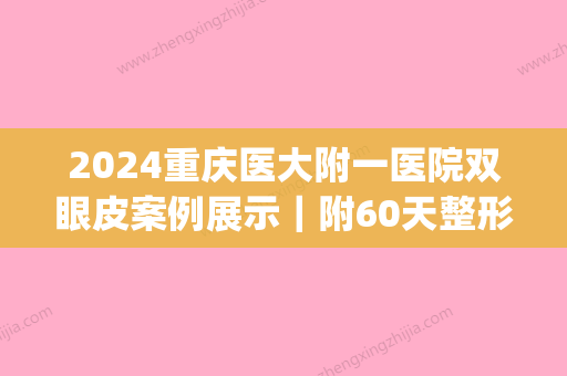 2024重庆医大附一医院双眼皮案例展示｜附60天整形果图(重庆第一附属医院做双眼皮)