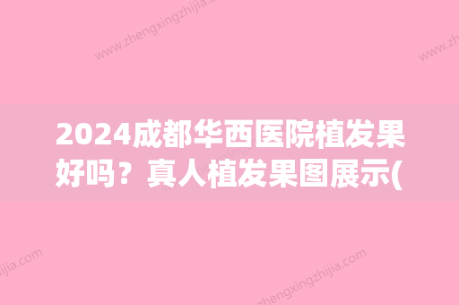 2024成都华西医院植发果好吗？真人植发果图展示(四川华西医院植发医生)