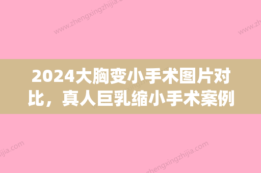 2024大胸变小手术图片对比，真人巨乳缩小手术案例一览(缩小胸的手术)