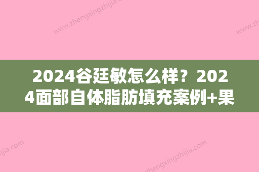 2024谷廷敏怎么样？2024面部自体脂肪填充案例+果图展示