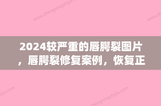 2024较严重的唇腭裂图片，唇腭裂修复案例，恢复正常容貌(唇腭裂三度修复后图片)