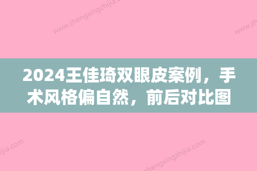 2024王佳琦双眼皮案例，手术风格偏自然	，前后对比图一览(王佳琦做的双眼皮)