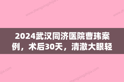 2024武汉同济医院曹玮案例，术后30天，清澈大眼轻松拥有(武汉同济医院吴鹏)